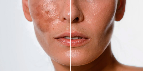Prevención del envejecimiento y las manchas Prevención del envejecimiento y las manchas