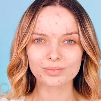 Acné: causas, tratamientos y cómo prevenir los brotes